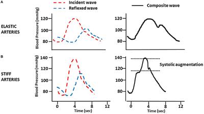 Chronic Kidney Disease and Arterial Stiffness: A Two-Way Path